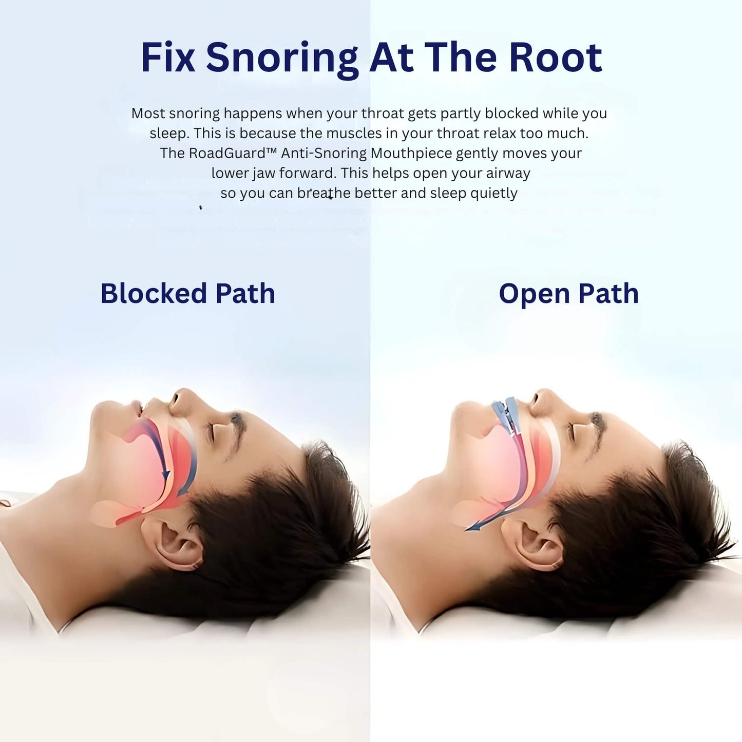 RoadGuard™ Anti-Snoring Mouthpiece